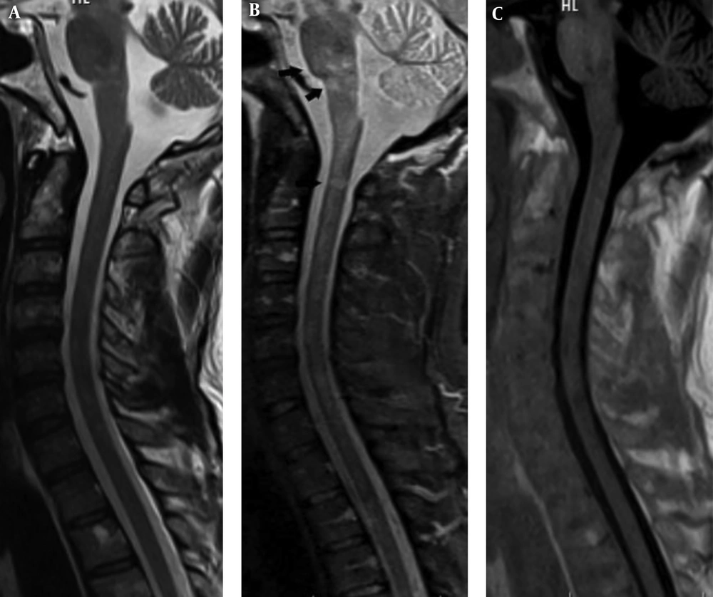 A 32-year-old woman with relapsing remitting multiple sclerosis (RRMS) who had a neurological attack. Sagittal images in T2 weighted turbo spin echo (T2W TSE) (A), short tau inversion recovery (STIR) (B) and phase sensitive inversion recovery (PSIR) (C) sequences have been shown. The patient has plaques in the pons, medulla oblongata and at the level of C2 that are not visible on PSIR and T2W TSE images, while it is delineated in STIR sequence (black arrows). Note the better lesion count in STIR compared to other sequences in this case. A 32-year-old woman with relapsing remitting multiple sclerosis (RRMS) who had a neurological attack. Sagittal images in T2 weighted turbo spin echo (T2W TSE) (A), short tau inversion recovery (STIR) (B) and phase sensitive inversion recovery (PSIR) (C) sequences have been shown. The patient has plaques in the pons, medulla oblongata and at the level of C2 that are not visible on PSIR and T2W TSE images, while it is delineated in STIR sequence (black arrows). Note the better lesion count in STIR compared to other sequences in this case.
