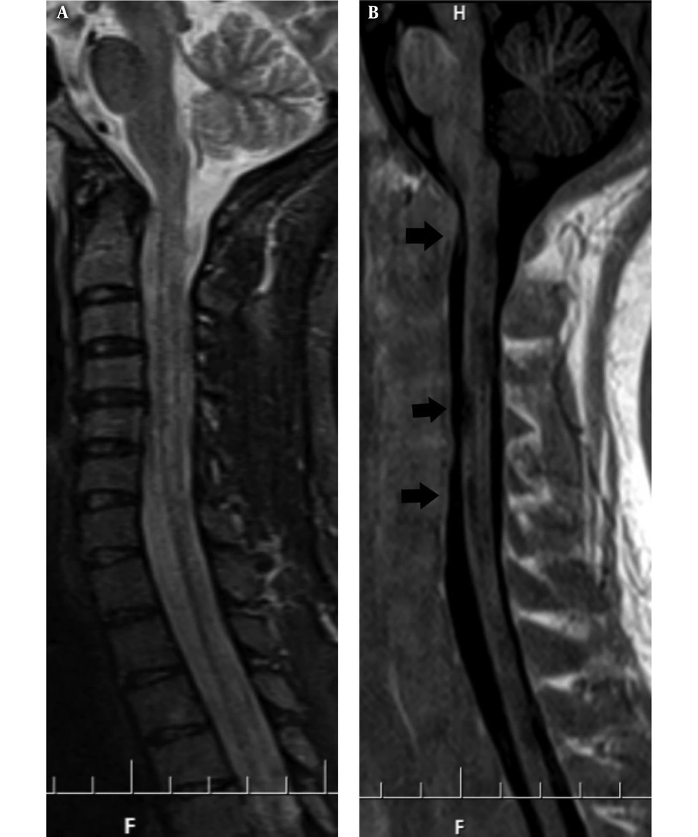 A 28-year-old female patient who is a known case of relapsing remitting multiple sclerosis (RRMS) on follow up. Sagittal short tau inversion recovery (STIR) image shows subtle high signal intensity (dirty white matter) without delineation local lesions at the cord (A). Sagittal phase sensitive inversion recovery (PSIR) shows multiple local hypointense lesions at the level of C2 - T2 (black arrows) (B). The lesions could be seen in a poor conspicuity in STIR, while in PSIR, it is better detected. A 28-year-old female patient who is a known case of relapsing remitting multiple sclerosis (RRMS) on follow up. Sagittal short tau inversion recovery (STIR) image shows subtle high signal intensity (dirty white matter) without delineation local lesions at the cord (A). Sagittal phase sensitive inversion recovery (PSIR) shows multiple local hypointense lesions at the level of C2 - T2 (black arrows) (B). The lesions could be seen in a poor conspicuity in STIR, while in PSIR, it is better detected.