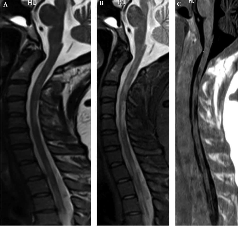 A 32-year-old male patient with secondary progressive multiple sclerosis (SPMS) who presented with tingling, numbness and weakness of both lower limbs. Sagittal T2 weighted turbo spin echo (T2W TSE) (A), short tau inversion recovery (STIR) (B) and phase sensitive inversion recovery (PSIR) (C) images show multiple MS plaques extending from C2 to T3. They display bright signal intensity (SI) on T2W TSE and STIR and low SI on PSIR. Note that lesions have more conspicuity in PSIR than STIR and T2 W images. A 32-year-old male patient with secondary progressive multiple sclerosis (SPMS) who presented with tingling, numbness and weakness of both lower limbs. Sagittal T2 weighted turbo spin echo (T2W TSE) (A), short tau inversion recovery (STIR) (B) and phase sensitive inversion recovery (PSIR) (C) images show multiple MS plaques extending from C2 to T3. They display bright signal intensity (SI) on T2W TSE and STIR and low SI on PSIR. Note that lesions have more conspicuity in PSIR than STIR and T2 W images.