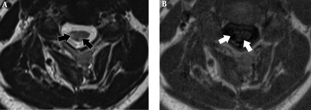 A 42-year-old patient with relapsing remitting multiple sclerosis (RRMS). Axial T2 weighted turbo spin echo (T2W TSE) (A). Axial phase sensitive inversion recovery (PSIR) (B). In both images, two plaques are seen in the cervical/spine. The lesion is clearer, the border is clear and differentiation between the lesion and the normal tissue is better in the PSIR sequence (white arrows) compared to T2W TSE (black arrows). A 42-year-old patient with relapsing remitting multiple sclerosis (RRMS). Axial T2 weighted turbo spin echo (T2W TSE) (A). Axial phase sensitive inversion recovery (PSIR) (B). In both images, two plaques are seen in the cervical/spine. The lesion is clearer, the border is clear and differentiation between the lesion and the normal tissue is better in the PSIR sequence (white arrows) compared to T2W TSE (black arrows).