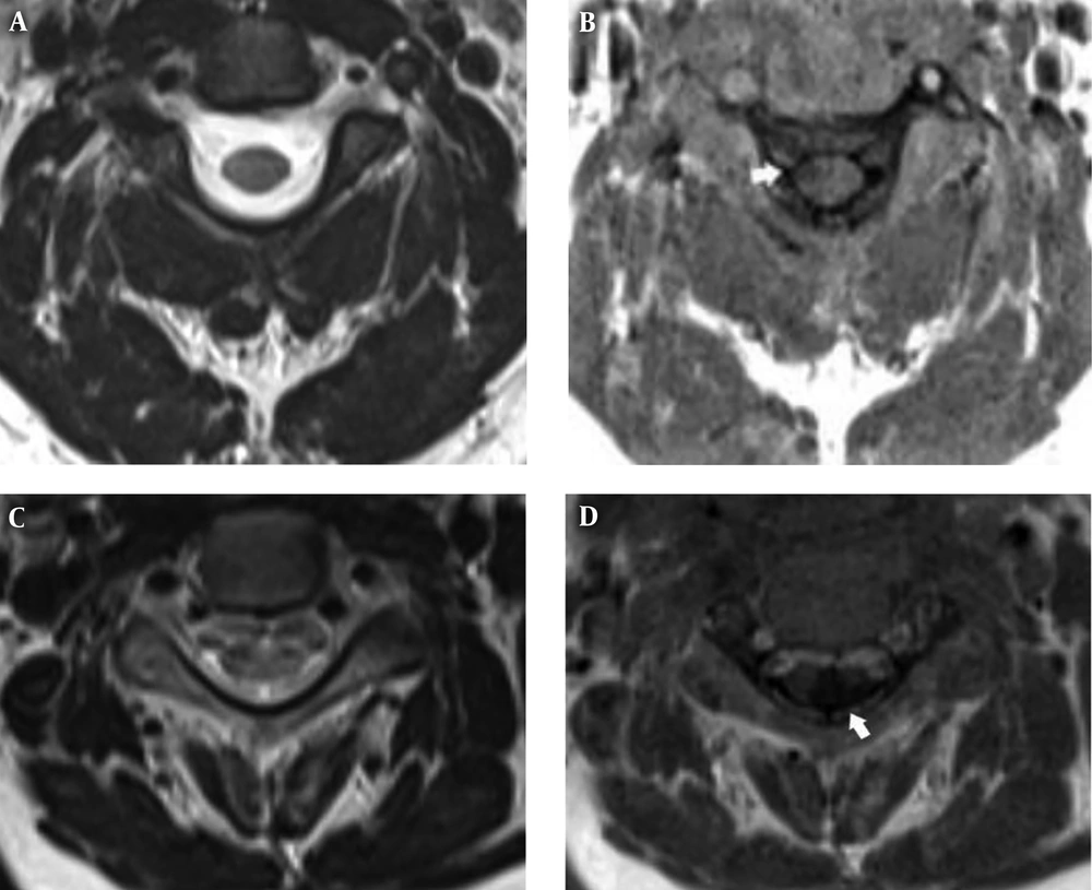 A 36-year-old woman with relapsing-remitting multiple sclerosis (RRMS) and upper extremity weakness (A and B). A 32-year-old man with secondary-progressive MS (SPMS) and upper and lower extremity paresthesia (C and D). Axial T2 weighted turbo spin echo (T2W TSE) (A and C). Axial phase sensitive inversion recovery (PSIR) (B and D). MS plaques are seen in PSIR sequence (white arrows) (B and D). No sign of plaques is detected in T2W TSE (A and C). A 36-year-old woman with relapsing-remitting multiple sclerosis (RRMS) and upper extremity weakness (A and B). A 32-year-old man with secondary-progressive MS (SPMS) and upper and lower extremity paresthesia (C and D). Axial T2 weighted turbo spin echo (T2W TSE) (A and C). Axial phase sensitive inversion recovery (PSIR) (B and D). MS plaques are seen in PSIR sequence (white arrows) (B and D). No sign of plaques is detected in T2W TSE (A and C).