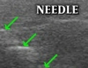 Accuracy of the Anatomic Placement in Ultrasonography Guided Facet Joint Blockage with Supervising of C-Arm Fluoroscopy