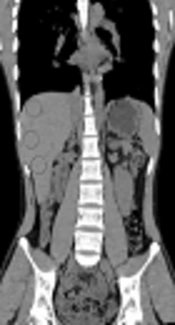Variability and Reliability of Normal Liver 18F-FDG Standardized Uptake Value in Relation to Placement of Volume of Interest