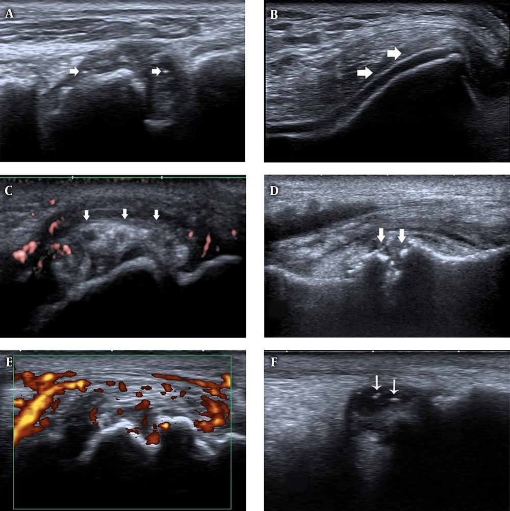 Ultrasound features of joints in first gout attack and asymptomatic hyperuricemia (AHU). A, First metatarso-phalangeal joints (1st MTP) longitudinal view, B-mode ultrasound shows synovial thickening and hyper echoic foci (white arrows) in patients with first gout attack. B, Knee transverse view, B-mode ultrasound shows double contour (DC) sign (white arrows) on the surface of the cartilage in patients with first gout attack. C, 1st MTP longitudinal view, tophi (white arrows) with surrounding power Doppler signal in patients with first gout attack. D, 1st MTP longitudinal view, bone erosion (white arrows) in patients with first gout attack. E, 1st MTP longitudinal view, synovial thickening and power Doppler signals in patients with first gout attack. F, Ankle longitudinal view, hyperechoic foci (white arrows) inside the synovial fluid. Ultrasound features of joints in first gout attack and asymptomatic hyperuricemia (AHU). A, First metatarso-phalangeal joints (1st MTP) longitudinal view, B-mode ultrasound shows synovial thickening and hyper echoic foci (white arrows) in patients with first gout attack. B, Knee transverse view, B-mode ultrasound shows double contour (DC) sign (white arrows) on the surface of the cartilage in patients with first gout attack. C, 1st MTP longitudinal view, tophi (white arrows) with surrounding power Doppler signal in patients with first gout attack. D, 1st MTP longitudinal view, bone erosion (white arrows) in patients with first gout attack. E, 1st MTP longitudinal view, synovial thickening and power Doppler signals in patients with first gout attack. F, Ankle longitudinal view, hyperechoic foci (white arrows) inside the synovial fluid.