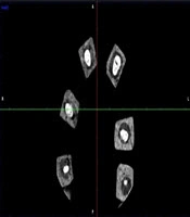 Cover image of the article: Effect of Artifact Reduction on the Diagnosis of Vertical Root Fracture in Teeth with Posts Using CBCT