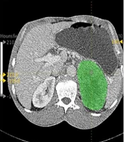 Value of CT-Based Texture Analysis in Preoperative Prediction of the Grade of Gastrointestinal Stromal Tumors Compared to Conventional CT Imaging