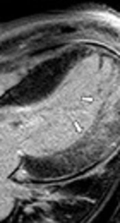 Left Ventricular Noncompaction with Bicuspid Aortic Valve: A Case Report with a Comprehensive Cardiac MRI Approach
