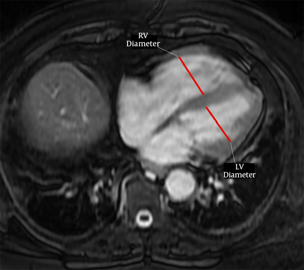 A 52-year-old male with pulmonary embolism and a pulmonary index of 47.5%, right ventricle (RV) and left ventricle (LV) diameter measurements on unenhanced MRI image A 52-year-old male with pulmonary embolism and a pulmonary index of 47.5%, right ventricle (RV) and left ventricle (LV) diameter measurements on unenhanced MRI image