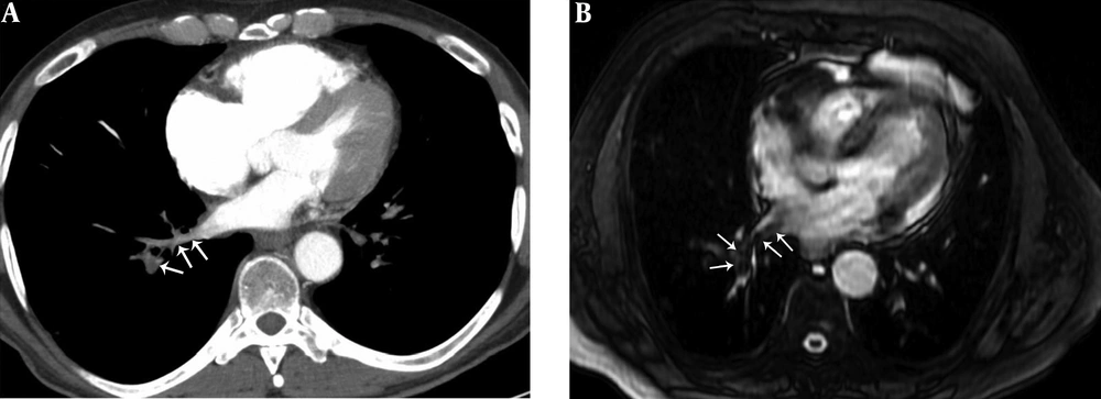 A 41-year-old male with pulmonary embolism and pulmonary embolism index was 75%. A, Axial contrast-enhanced computed tomography pulmonary angiography image shows hypoattenuating filling defect in the right lower lobe pulmonary vein (arrows). B, Axial unenhanced steady-state free precession (SSFP) magnetic resonance image shows hypointense filling defect in the right lower lobe pulmonary vein (arrows). A 41-year-old male with pulmonary embolism and pulmonary embolism index was 75%. A, Axial contrast-enhanced computed tomography pulmonary angiography image shows hypoattenuating filling defect in the right lower lobe pulmonary vein (arrows). B, Axial unenhanced steady-state free precession (SSFP) magnetic resonance image shows hypointense filling defect in the right lower lobe pulmonary vein (arrows).