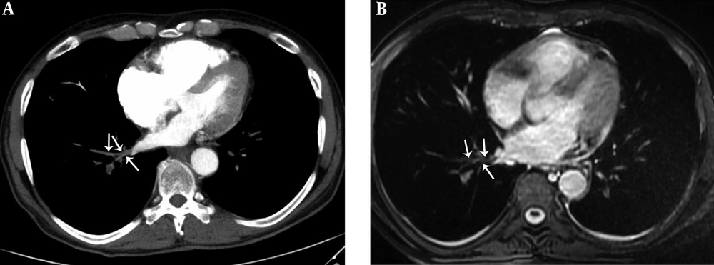 A 29-year-old male with pulmonary embolism and pulmonary embolism index was 62.5%. A, Axial contrast-enhanced computed tomography pulmonary angiography image shows hypoattenuating filling defect in the right lower lobe pulmonary vein (arrows). B, Axial unenhanced steady-state free precession (SSFP) magnetic resonance image shows hypointense filling defect in the right lower lobe pulmonary vein (arrows). A 29-year-old male with pulmonary embolism and pulmonary embolism index was 62.5%. A, Axial contrast-enhanced computed tomography pulmonary angiography image shows hypoattenuating filling defect in the right lower lobe pulmonary vein (arrows). B, Axial unenhanced steady-state free precession (SSFP) magnetic resonance image shows hypointense filling defect in the right lower lobe pulmonary vein (arrows).