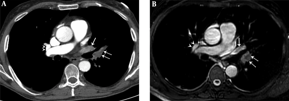 A 36-year-old female with pulmonary embolism and pulmonary embolism index was 80%. A, Axial contrast-enhanced computed tomography pulmonary angiography image shows hypoattenuating filling defect in the left upper lobe pulmonary artery (dashed arrows), hypoattenuating filling defect in the left upper lobe pulmonary vein (arrow). Normal contrast filling in the right upper lobe pulmonary vein is also seen (arrowheads). B, Axial unenhanced steady-state free precession (SSFP) magnetic resonance image shows hypointense filling defect in the left upper lobe pulmonary artery (dashed arrows) and hypointense filling defect in the left upper lobe pulmonary vein (arrow). Normal signal features in the right upper lobe pulmonary vein are also seen (arrowheads). A 36-year-old female with pulmonary embolism and pulmonary embolism index was 80%. A, Axial contrast-enhanced computed tomography pulmonary angiography image shows hypoattenuating filling defect in the left upper lobe pulmonary artery (dashed arrows), hypoattenuating filling defect in the left upper lobe pulmonary vein (arrow). Normal contrast filling in the right upper lobe pulmonary vein is also seen (arrowheads). B, Axial unenhanced steady-state free precession (SSFP) magnetic resonance image shows hypointense filling defect in the left upper lobe pulmonary artery (dashed arrows) and hypointense filling defect in the left upper lobe pulmonary vein (arrow). Normal signal features in the right upper lobe pulmonary vein are also seen (arrowheads).