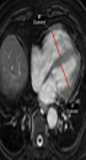 Pulmonary Vein Sign on Unenhanced-MRI as a Sign of Severe Pulmonary Embolism