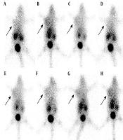 Evaluating Changes of Tumor Hypoxia Using 99Tcm-MNLS Hypoxic Imaging