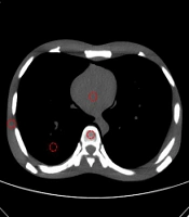 Effect of Arm Position on Image Quality and Radiation Dose in Multidetector Computed Tomography
