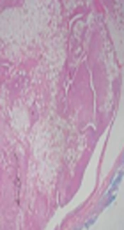 Hyperechoic Appearance of Malignant Phyllodes Tumor with Liposarcomatous Differentiation: A Case Report with Pathologic Correlation