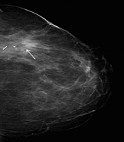 Fat Necrosis in the Post-Surgical Breast: Dependence on Adjuvant Treatment and Morphology on Digital Mammography