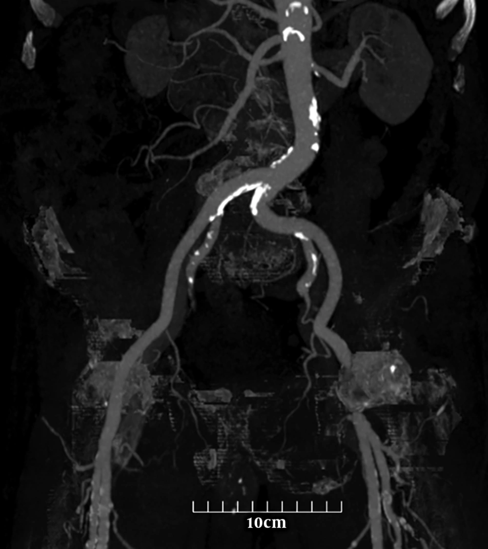 A 56-year-old man with no significant medical history presented with complaints of non-traumatic abdominal pain. To evaluate a patient with suspected vascular disease, a noncontrast computed tomography scan of the abdomen and pelvis was performed. Less calcification formation in the external iliac artery compared to adjacent arteries is seen. The calcium content of each artery was calculated with semi-automated software. The scores are as follows: Aorta: 6779.8, right common iliac artery (CIA): 1016.5, left CIA: 290.1, right external iliac artery (EIA):0, left EIA:0, right common femoral artery (CFA):548.7, and left CFA: 416.9. A 56-year-old man with no significant medical history presented with complaints of non-traumatic abdominal pain. To evaluate a patient with suspected vascular disease, a noncontrast computed tomography scan of the abdomen and pelvis was performed. Less calcification formation in the external iliac artery compared to adjacent arteries is seen. The calcium content of each artery was calculated with semi-automated software. The scores are as follows: Aorta: 6779.8, right common iliac artery (CIA): 1016.5, left CIA: 290.1, right external iliac artery (EIA):0, left EIA:0, right common femoral artery (CFA):548.7, and left CFA: 416.9.