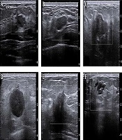 Classification of Breast Ultrasound Tomography by Using Textural Analysis