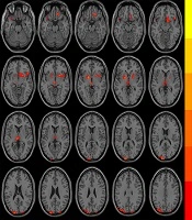 Short-Term Effects of Flupentixol-Melitracen on Regional Brain Function in Patients with Irritable Bowel Syndrome: An fMRI Study