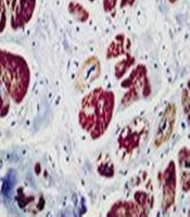 Evaluation of Late Gadolinium Enhancement and Cardiac Cine-MRI Based on Artificial Intelligence in a Patient with Selenium Deficiency Cardiomyopathy (Keshan Disease): A Case Report