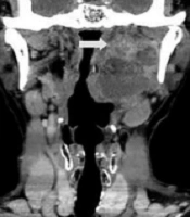 Imaging Findings of a Myxofibrosarcoma in the Parapharyngeal Space: A Case Report