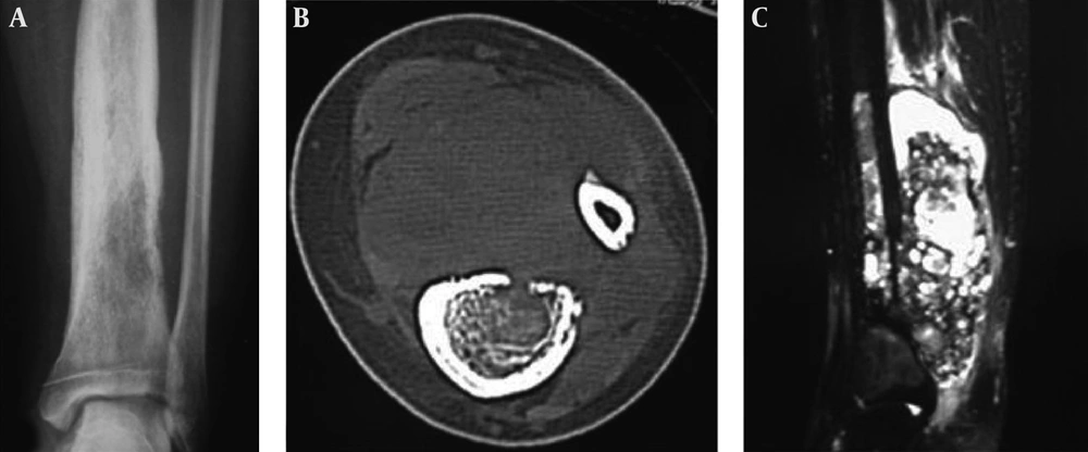 A 22-year-old girl who had a telangiectatic osteosarcoma in the left tibia. A and B, A lytic lesion with adjacent sclerotic changes is shown with ill-defined margins. The cortex is eroded and irregularly thickened; C, Fat suppression sequence of T2-weighted imaging (T2WI) of magnetic resonance imaging revealed the bone lesion and mixed hyperintense signal in the soft tissue mass. A 22-year-old girl who had a telangiectatic osteosarcoma in the left tibia. A and B, A lytic lesion with adjacent sclerotic changes is shown with ill-defined margins. The cortex is eroded and irregularly thickened; C, Fat suppression sequence of T2-weighted imaging (T2WI) of magnetic resonance imaging revealed the bone lesion and mixed hyperintense signal in the soft tissue mass.