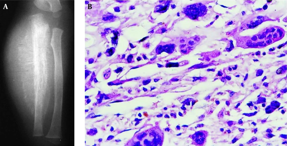 A 1.5-year-old boy had a telangiectatic osteosarcoma in the ulna. A, The lesion is lytic with radiating periosteal reaction, a soft tissue mass and Codman triangle similar to conventional osteosarcoma; B, The histopathological staining shows heterocysts and atypical karyodieresis in the septa (H&E 400×). A 1.5-year-old boy had a telangiectatic osteosarcoma in the ulna. A, The lesion is lytic with radiating periosteal reaction, a soft tissue mass and Codman triangle similar to conventional osteosarcoma; B, The histopathological staining shows heterocysts and atypical karyodieresis in the septa (H&E 400×).
