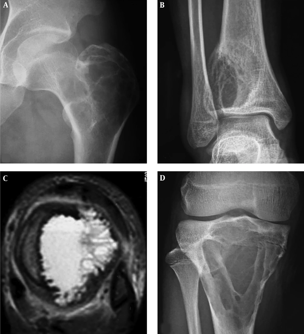 A, A 22-year-old man with an intertrochanteric aneurysmal bone cyst (ABC) with a bone destruction lesion and multiple cysts, clear margins and coarse septa; B and C, A 15-year-old girl with a tibial ABC; B, A Cystic lytic destructive lesion is seen in the distal tibia with clear margins and coarse septations; C, T2-weighted imaging (T2WI) magnetic resonance imaging demonstrated fluid-fluid levels; D, A 17-year-old boy with a tibial ABC and a cystic lytic lesion, thinned cortex, coarse septa and clear margins. A, A 22-year-old man with an intertrochanteric aneurysmal bone cyst (ABC) with a bone destruction lesion and multiple cysts, clear margins and coarse septa; B and C, A 15-year-old girl with a tibial ABC; B, A Cystic lytic destructive lesion is seen in the distal tibia with clear margins and coarse septations; C, T2-weighted imaging (T2WI) magnetic resonance imaging demonstrated fluid-fluid levels; D, A 17-year-old boy with a tibial ABC and a cystic lytic lesion, thinned cortex, coarse septa and clear margins.