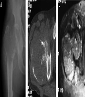 Cover image of the article: Comparison of the Imaging and Pathological Features of Telangiectatic Osteosarcoma and Aneurysmal Bone Cyst of Long Tubular Bones
