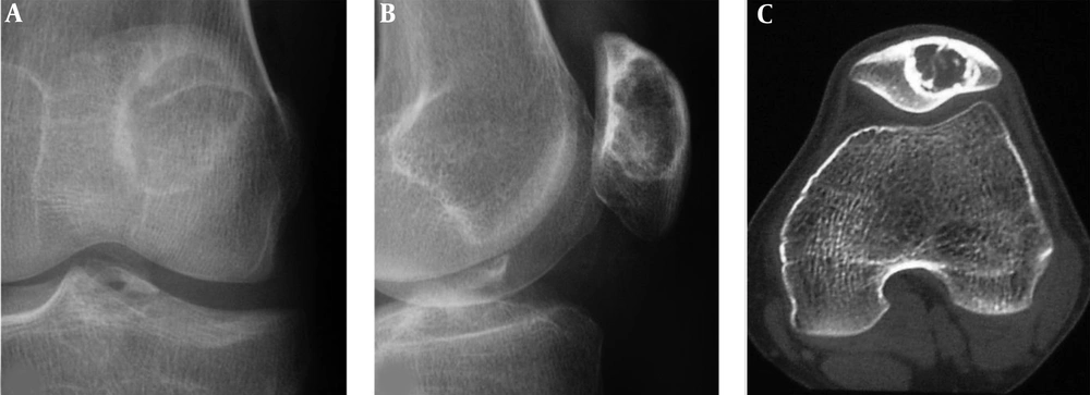 A patellar chondroblastoma is demonstrated in a 19-year-old boy who had knee pain for 2 years. Plain radiographs (A and B) and computed tomography (C) shows a lucent lesion in the left patella with sclerotic rims, inhomogeneous density and irregular calcification inside the lesion. The trochlear groove is shallow (C). A patellar chondroblastoma is demonstrated in a 19-year-old boy who had knee pain for 2 years. Plain radiographs (A and B) and computed tomography (C) shows a lucent lesion in the left patella with sclerotic rims, inhomogeneous density and irregular calcification inside the lesion. The trochlear groove is shallow (C).