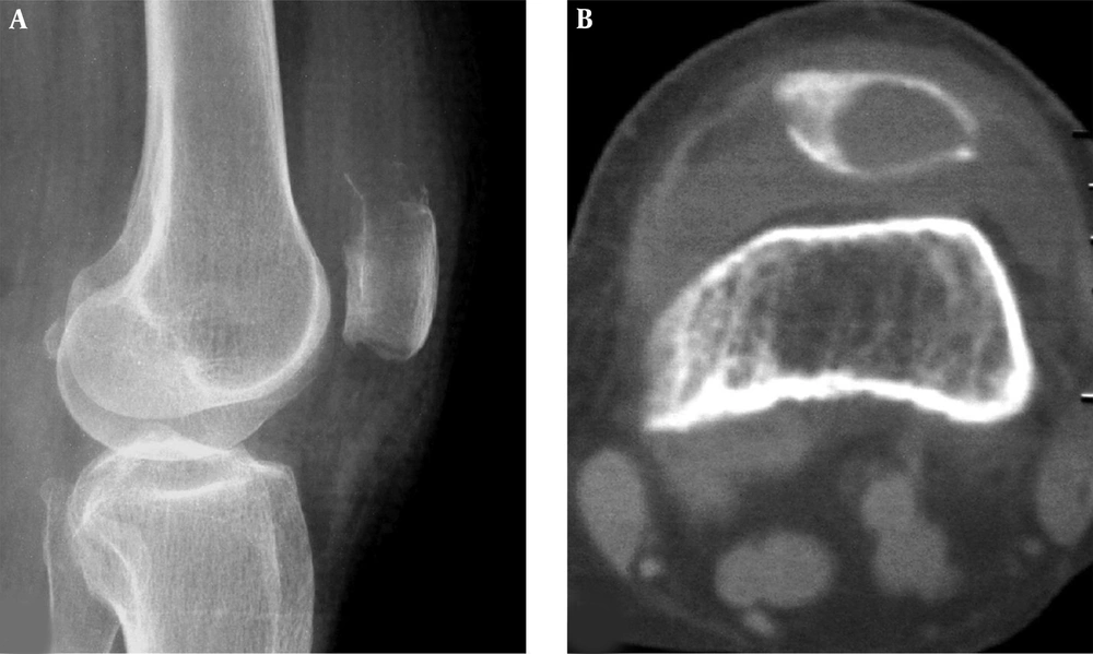 A patellar metastatic adenocarcinoma is shown. A lytic destruction area is demonstrated in the upper extremity of the patella with ill-defined margins and swelling joint capsule in plain radiography (A) and computed tomography (B). The trochlear groove is flat. A patellar metastatic adenocarcinoma is shown. A lytic destruction area is demonstrated in the upper extremity of the patella with ill-defined margins and swelling joint capsule in plain radiography (A) and computed tomography (B). The trochlear groove is flat.