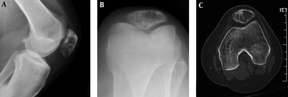 A well-differentiated osteosarcoma is shown in the patella. A and B, Radiographs demonstrate decreased density in the lower extremity of the patella with interrupted cortex. C, Computed tomography reveals expansive lytic destruction with thinned cortex and interrupted cortex in the interior bottom similar to a benign lesion. The trochlear groove is relatively shallow with a smaller LPI (lateral pulley inclination). A well-differentiated osteosarcoma is shown in the patella. A and B, Radiographs demonstrate decreased density in the lower extremity of the patella with interrupted cortex. C, Computed tomography reveals expansive lytic destruction with thinned cortex and interrupted cortex in the interior bottom similar to a benign lesion. The trochlear groove is relatively shallow with a smaller LPI (lateral pulley inclination).
