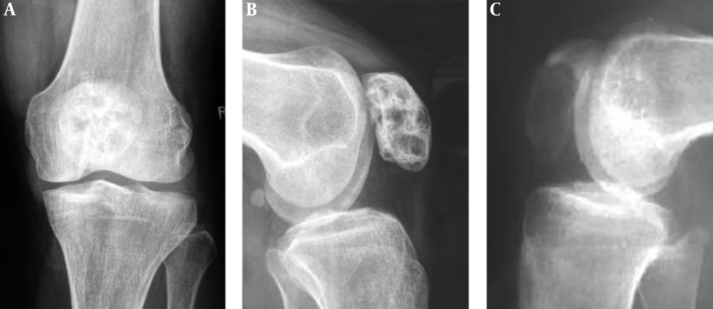 Patellar fibrous dysplasia and bone cyst are demonstrated. A and B, Plain radiographs reveal inhomogeneous destruction like a beehive in the patella with coarse septations and high density inside the lesion. C, A patellar bone cyst demonstrates it as lytic destruction with relative homogeneous density inside the lesion. Patellar fibrous dysplasia and bone cyst are demonstrated. A and B, Plain radiographs reveal inhomogeneous destruction like a beehive in the patella with coarse septations and high density inside the lesion. C, A patellar bone cyst demonstrates it as lytic destruction with relative homogeneous density inside the lesion.