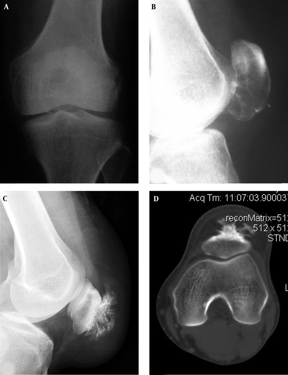 Patellar aneurysmal bone cyst and parosteal lipoma are shown. A and B, The patellar aneurysmal bone cyst demonstrates an expansive lytic destruction area in the lower half of the patella with fine and thin septations inside the lesion. C and D, The parosteal lipoma is shown as soft tissue in front of the patella with fatty density and branches of bone protrusions connected to the patella front part. The trochlear groove is relatively shallow with smaller lateral pulley inclination (LPI) (D). Patellar aneurysmal bone cyst and parosteal lipoma are shown. A and B, The patellar aneurysmal bone cyst demonstrates an expansive lytic destruction area in the lower half of the patella with fine and thin septations inside the lesion. C and D, The parosteal lipoma is shown as soft tissue in front of the patella with fatty density and branches of bone protrusions connected to the patella front part. The trochlear groove is relatively shallow with smaller lateral pulley inclination (LPI) (D).