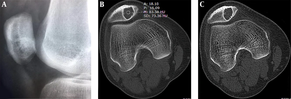 Patellar hemangioma. Plain radiograph (A) and CT scan (B and C) demonstrate an eccentric lesion with well-defined, sclerotic margins. The CT value inside the lesion is relatively high (B) with interior calcification (C). Bone crests are formed at the edge (C). The trochlear groove is shallow and flat with a smaller LPI (lateral pulley inclination). Patellar hemangioma. Plain radiograph (A) and CT scan (B and C) demonstrate an eccentric lesion with well-defined, sclerotic margins. The CT value inside the lesion is relatively high (B) with interior calcification (C). Bone crests are formed at the edge (C). The trochlear groove is shallow and flat with a smaller LPI (lateral pulley inclination).