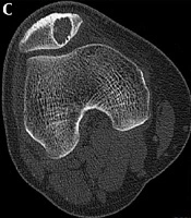 Patellofemoral Morphology and Imaging Features of Patellar Tumors and Tumor-Like Lesions