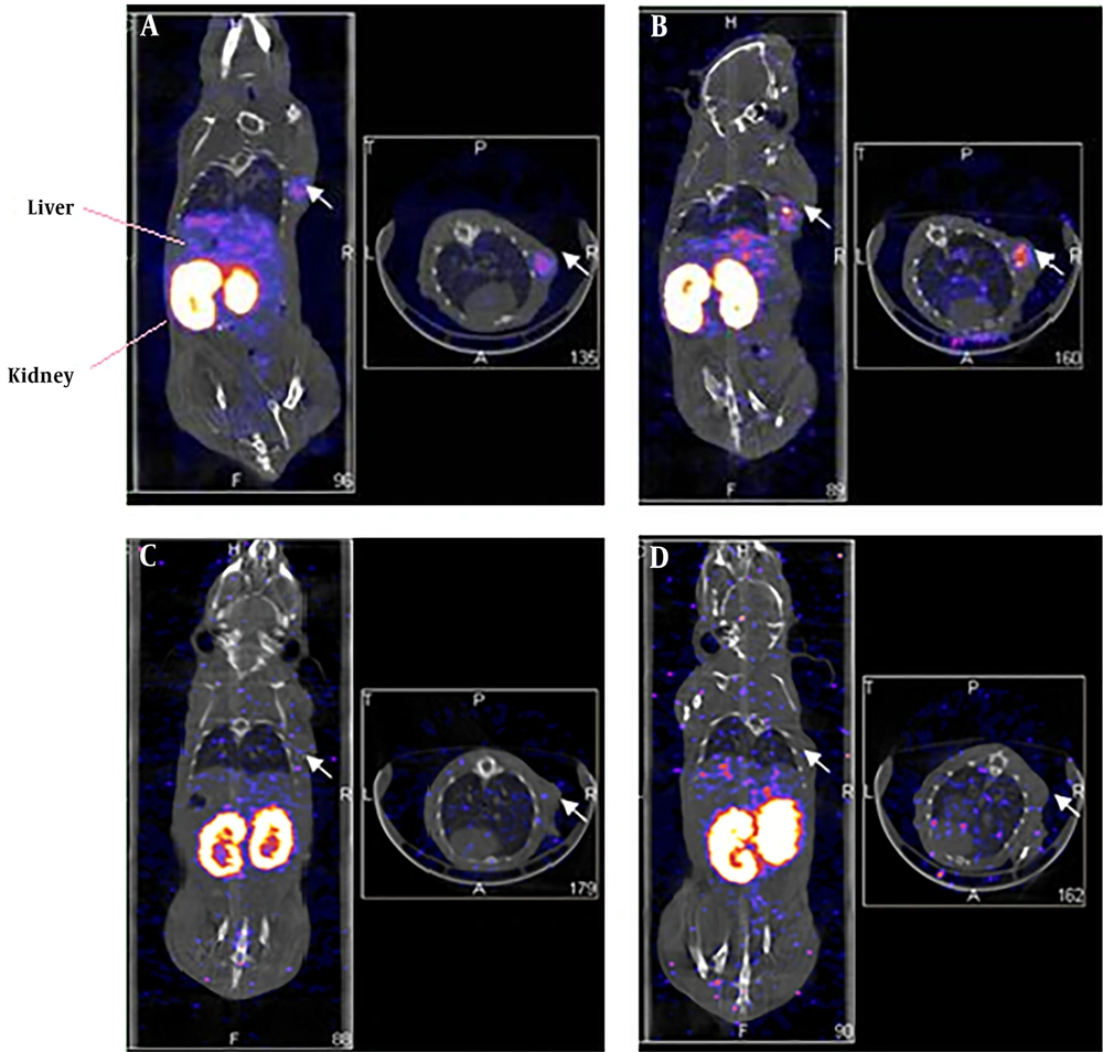 Single-photon emission computed tomography (SPECT)/CT imaging of <sup>99m</sup>Tc-labeled human epidermal growth factor receptor 2 (HER2) affibody in human HER2-positive breast carcinoma in xenografted mice (left: coronal plane; right: transverse plane). A and B, Images of <sup>99m</sup>Tc-ABH2 at 1h (A) and 4.5h (B), white arrows point radioactivity accumulated MDA-MB-361 breast carcinoma. C and D, Blocking images of <sup>99m</sup>Tc-ABH2 at 1h (C) and 4.5h (D), radioactivity was not accumulated in MDA-MB-361 breast carcinoma. Single-photon emission computed tomography (SPECT)/CT imaging of <sup>99m</sup>Tc-labeled human epidermal growth factor receptor 2 (HER2) affibody in human HER2-positive breast carcinoma in xenografted mice (left: coronal plane; right: transverse plane). A and B, Images of <sup>99m</sup>Tc-ABH2 at 1h (A) and 4.5h (B), white arrows point radioactivity accumulated MDA-MB-361 breast carcinoma. C and D, Blocking images of <sup>99m</sup>Tc-ABH2 at 1h (C) and 4.5h (D), radioactivity was not accumulated in MDA-MB-361 breast carcinoma.