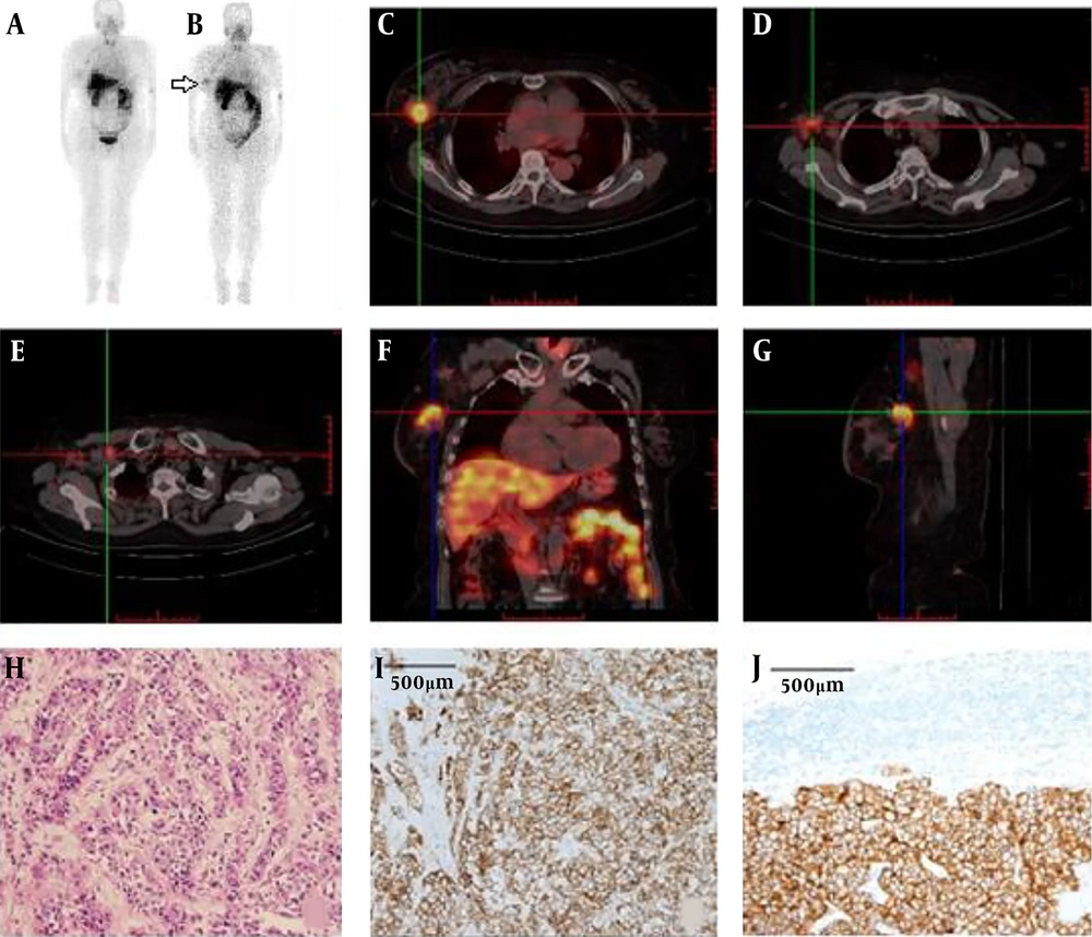 Maximum-intensity-projection (MIP) images obtained from patient No. 1 (i.e., at 60 years of age, and body weight (BW) of 70 kg) at 1.5 h (A), and 4.5 h (B) following administration of 370 MBq (50 μg) of <sup>99m</sup>Tc-labeled affibody. The breast cancer lesion (C), axillary lymph node (D) and supraclavicular lymph node (E) were clearly visible by transverse plane sectioning. Uptake of non-specific radioactivity by the liver and intestine were noted by coronal plane image analysis (F). The breast cancer lesion displaying human epidermal growth factor receptor 2 (HER2) overexpression was prominent in the sagittal plane (G). All lesions were surgically removed and histologically diagnosed as invasive ductal carcinoma (H). Analysis of HER2 immuno-histochemical staining of the primary tumor (I) and lymph node (J) of patient No. 1, showing (3+) staining intensity. Maximum-intensity-projection (MIP) images obtained from patient No. 1 (i.e., at 60 years of age, and body weight (BW) of 70 kg) at 1.5 h (A), and 4.5 h (B) following administration of 370 MBq (50 μg) of <sup>99m</sup>Tc-labeled affibody. The breast cancer lesion (C), axillary lymph node (D) and supraclavicular lymph node (E) were clearly visible by transverse plane sectioning. Uptake of non-specific radioactivity by the liver and intestine were noted by coronal plane image analysis (F). The breast cancer lesion displaying human epidermal growth factor receptor 2 (HER2) overexpression was prominent in the sagittal plane (G). All lesions were surgically removed and histologically diagnosed as invasive ductal carcinoma (H). Analysis of HER2 immuno-histochemical staining of the primary tumor (I) and lymph node (J) of patient No. 1, showing (3+) staining intensity.