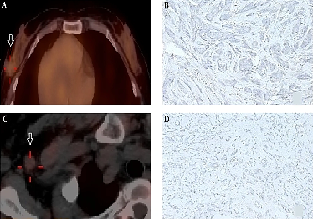Negative image (A) in SPECT with <sup>99m</sup>Tc-labeled affibody in breast cancer lesion of an invasive ductal carcinoma (IDC) (white arrow) patient (No. 22) showed negative pattern of staining in human epidermal growth factor receptor 2 (HER2) immunohistochemistry (B); A patient (No. 8) diagnosed as invasive lobular carcinoma (ILC) also displayed negative uptake with <sup>99m</sup>Tc-labeled affibody (white arrow) (C) and matched negative HER2 expression (D). Negative image (A) in SPECT with <sup>99m</sup>Tc-labeled affibody in breast cancer lesion of an invasive ductal carcinoma (IDC) (white arrow) patient (No. 22) showed negative pattern of staining in human epidermal growth factor receptor 2 (HER2) immunohistochemistry (B); A patient (No. 8) diagnosed as invasive lobular carcinoma (ILC) also displayed negative uptake with <sup>99m</sup>Tc-labeled affibody (white arrow) (C) and matched negative HER2 expression (D).