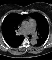 Use of Low-dose Chest CT Scan in the Evaluation of Breast Composition According to the Recommendations of BI-RADS Atlas-Fifth Edition