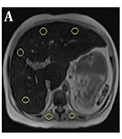 Water Only Sequence: An Accurate Method to Estimate Hepatic Siderosis in Patients with Thalassemia Major and Intermedia