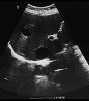 The Cystic Hepatic Mesenchymal Hamartoma in an Adult Mistaken for Hydatid Disease: Case Report