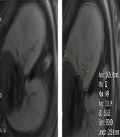 Standard Normal Fetal Lung Volume by MRI Measurement