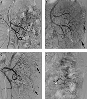 Evaluation of Transcatheter Arterial Embolization in Treating Gastrointestinal Bleeding Due to Angiodysplasia: A Retrospective Study on Twelve Cases