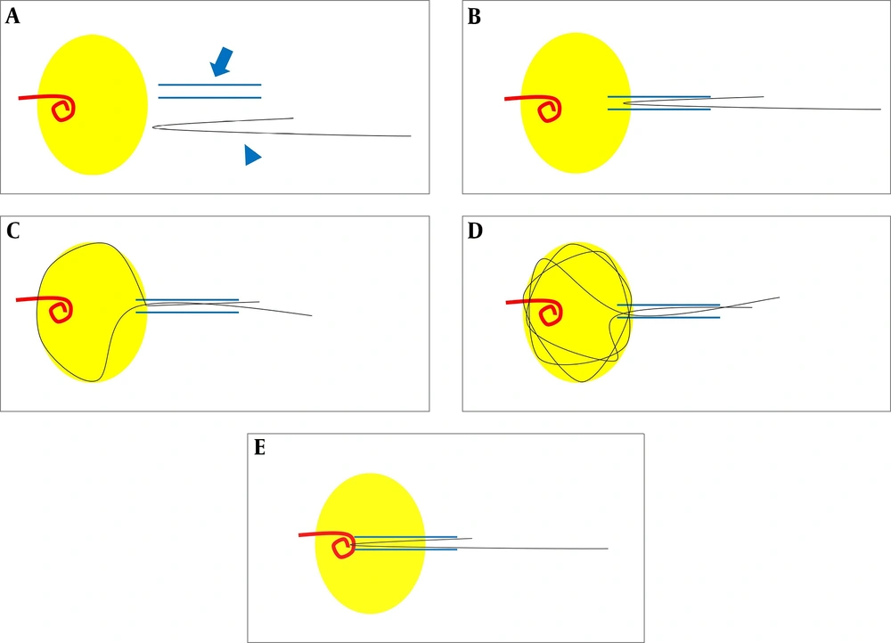 A, Prepare the introducer sheath (blue arrow) and a 0.018-inch guide-wire (blue arrowhead). Bend the end of the guide-wire as much as the sheath length. The yellow circle represents the lumen, such as a bladder or a renal pelvis; B, Insert the introducer sheath in the lumen and push the bent end of the guide-wire through the sheath; C, Create a loop by pushing the long string. The short string should be held to prevent the folded end from entering the lumen; D, When the long string is inserted continuously, the loop touches the lumen wall, and multiple loops are created due to the elasticity of the guide-wire; E, If a foreign body enters the loops, pull the short string and the long string simultaneously and guide both strings into the sheath. Finally, remove the foreign body along with the sheath. A, Prepare the introducer sheath (blue arrow) and a 0.018-inch guide-wire (blue arrowhead). Bend the end of the guide-wire as much as the sheath length. The yellow circle represents the lumen, such as a bladder or a renal pelvis; B, Insert the introducer sheath in the lumen and push the bent end of the guide-wire through the sheath; C, Create a loop by pushing the long string. The short string should be held to prevent the folded end from entering the lumen; D, When the long string is inserted continuously, the loop touches the lumen wall, and multiple loops are created due to the elasticity of the guide-wire; E, If a foreign body enters the loops, pull the short string and the long string simultaneously and guide both strings into the sheath. Finally, remove the foreign body along with the sheath.