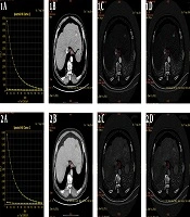 Application of Gemstone CT Spectroscopy in the Evaluation of Abnormal Enhancement of Lesion Margin After Radiofrequency Ablation of Hepatocellular Carcinoma