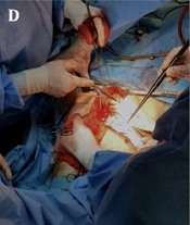 Bilateral Lumbar Erector Spinae Plane Block for Pain Control in Open Ureteric Repair and Reimplant: A Case Report