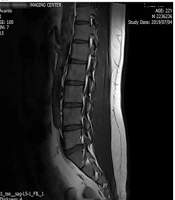 Biomarker of Urinary Malondialdehyde and Tumor Necrosis Factor-Alpha with Pain Progress in a Patient with Low Back Pain
