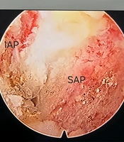 “Double Compression” at L5 – S1: A Case Treated with a Minimally Invasive Spine Endoscopic Pain Procedure (MisEpp)