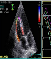 A Prospective Study of Right Ventricular Function After Coronary Artery Bypass Grafting: Are Usual Echocardiographic Parameters Useful?